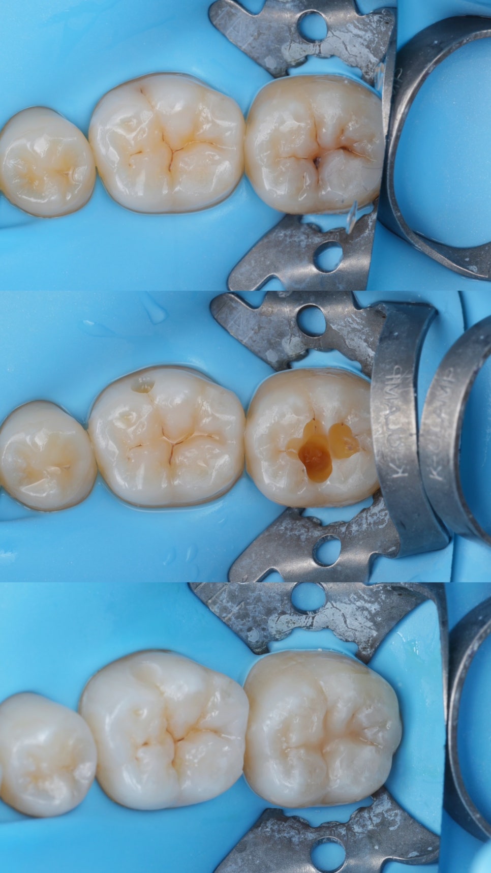 어금니 충치를 레진 스탬프 테크닉으로 치료해 보세요 관련 이미지 1