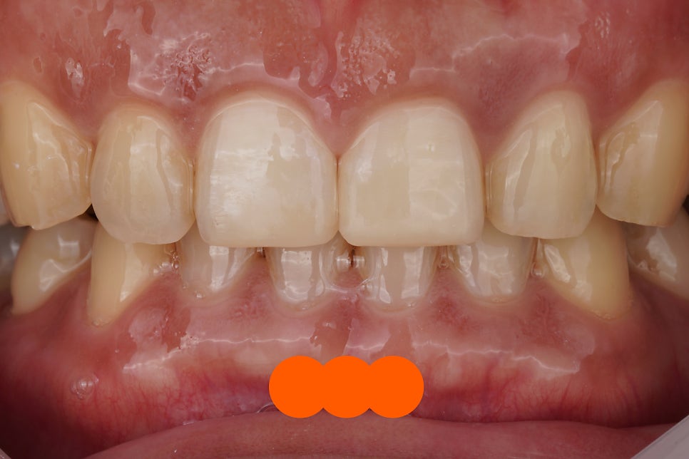 앞니 깨짐, 레진으로 1시간만에 감쪽같이 치료해드렸습니다. 관련 이미지 2