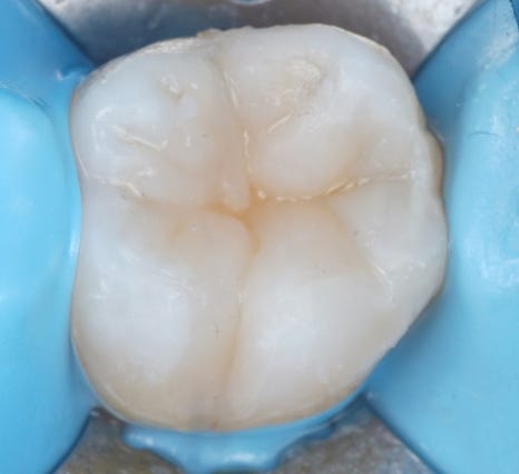 인레이치료 하방 2차 충치 레진 빌드업 사례 관련 이미지 15