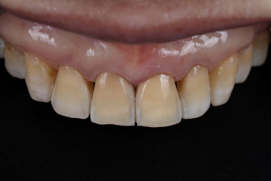 레진 변색 재치료, 다시 깨끗하게 만들어 볼까요? 관련 이미지 2