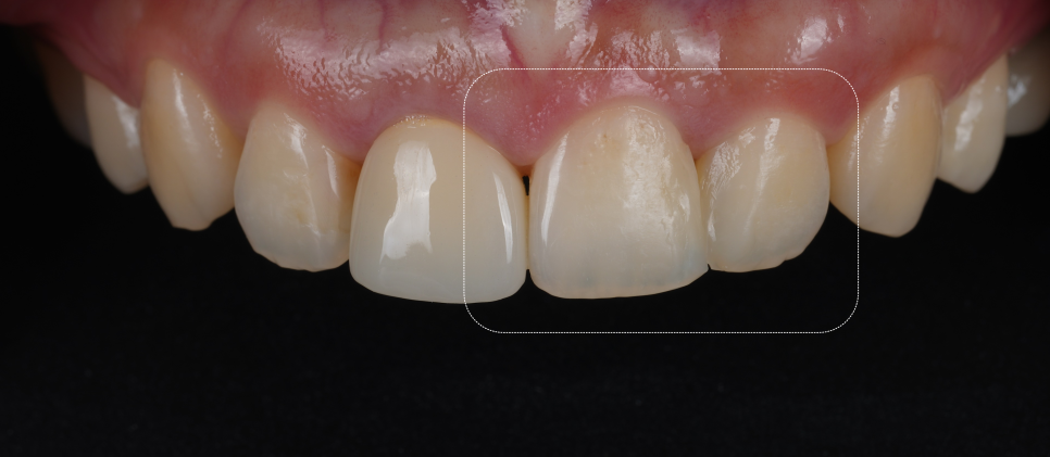 서초동치과 전라도 광주에서 레진 재치료 받으러 오신 사례 관련 이미지 1