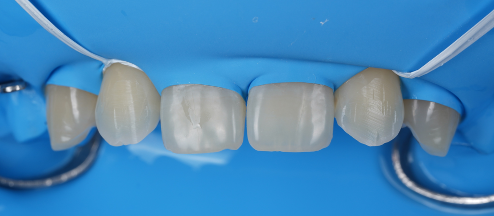 Apgujeong Dental Clinic: 3 Things Needed for Successful Resin Treatment of Peg Laterals image 9