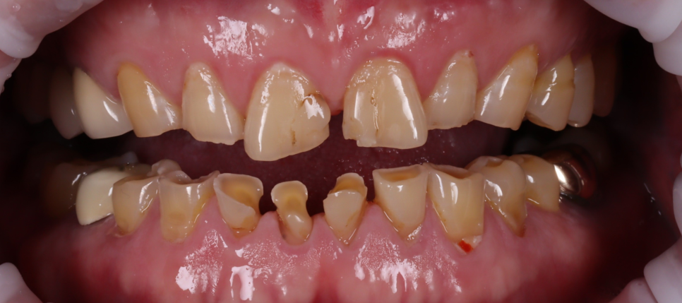 앞니 크라운 브릿지 재치료 시 이럴 땐 따로 제작해야 돼요 관련 이미지 2