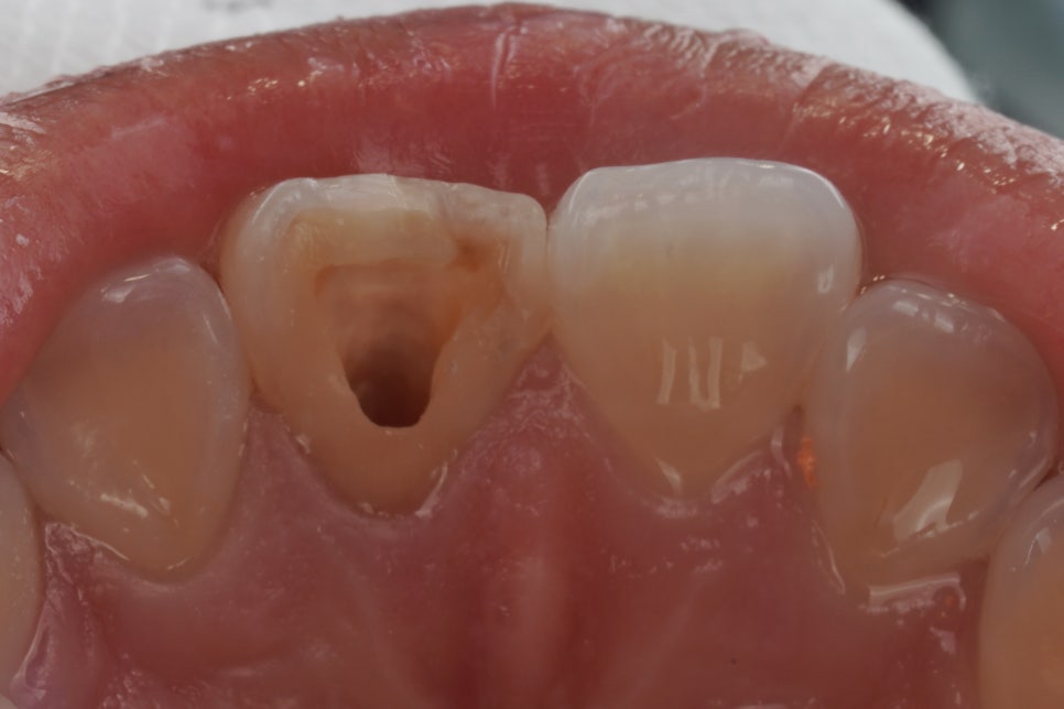 앞니 신경치료 변색 원인과 치료법인 실활치 미백 관련 이미지 5