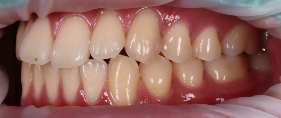 역삼역 치과 치대생 깊은 충치 신경치료없이 레진으로 완료 관련 이미지 5