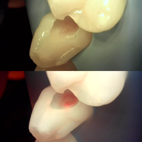 역삼역 치과 치대생 깊은 충치 신경치료없이 레진으로 완료 관련 이미지 10