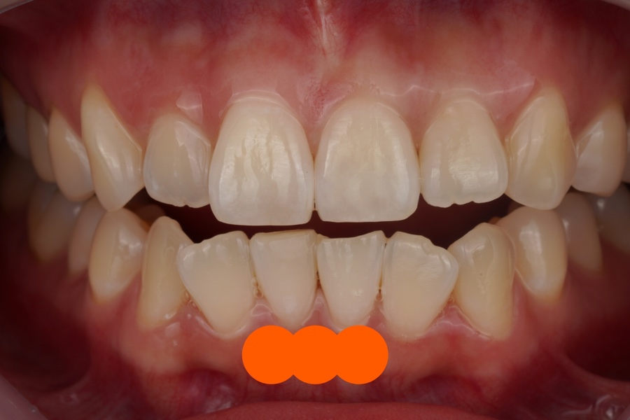 서초동 반점치 레진, 웨딩 촬영 전 앞니 치과치료 관련 이미지 3