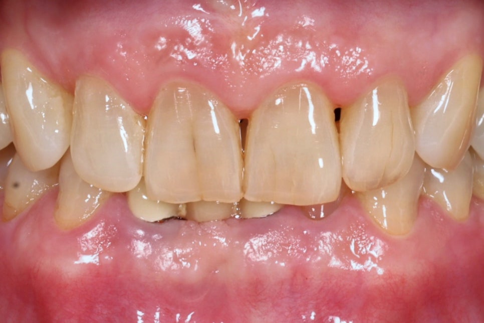 앞니 실금, 부모님 나이 든 치아 라미네이트 건강선물 관련 이미지 1