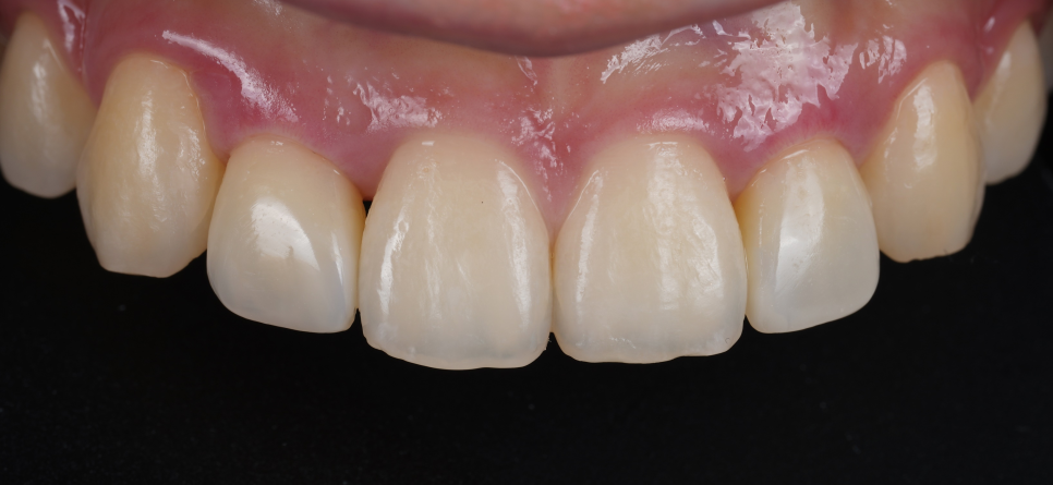 Seocho Dental Clinic Case of Gummy Contouring and Resin Treatment for a Peg Lateral Tooth in an Out-of-Town Dental Hygienist image 9