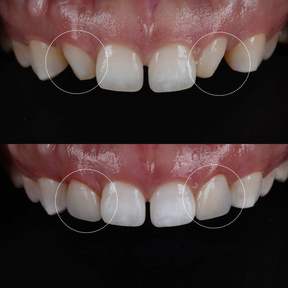 앞니 왜소치 레진 치과의사 소개로 내원해 당일 완료 관련 이미지 10