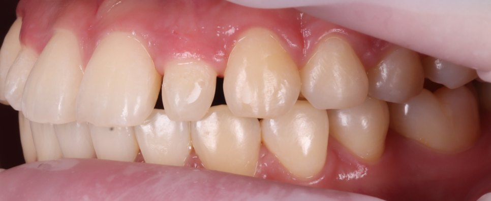 Seocho Dental Clinic Case of Gummy Contouring and Resin Treatment for a Peg Lateral Tooth in an Out-of-Town Dental Hygienist image 4