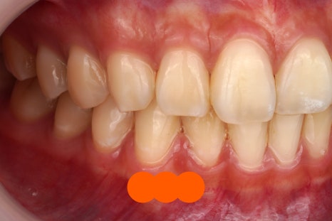 강남역 근처 치과, 투스젬 제거는 여기로 와야합니다 관련 이미지 5