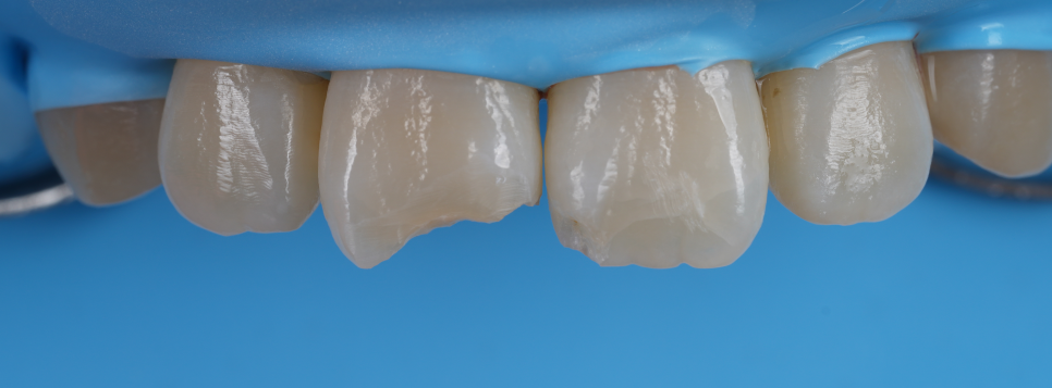 반포동치과 앞니 깨짐 레진 삭제 없이 당일에 치료 끝 관련 이미지 7