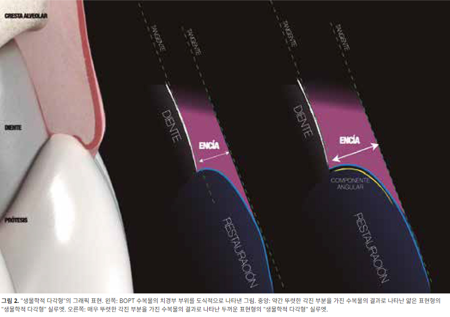 신논현역치과 심하게 마모된 60대 남성 앞니 크라운 치료 관련 이미지 7