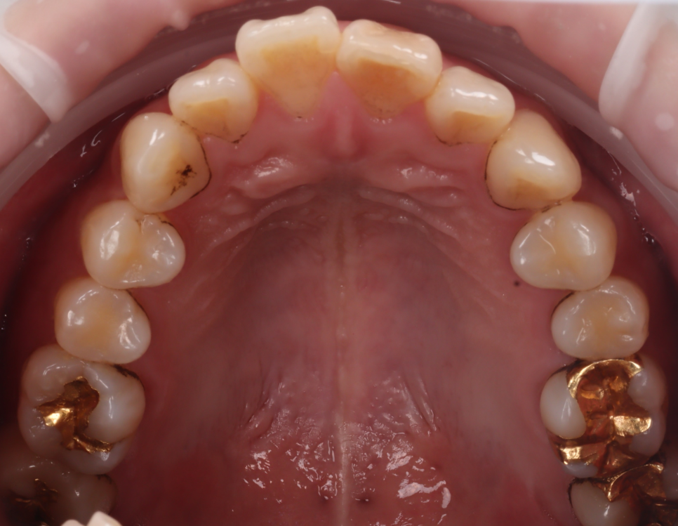 서초동치과 착색 고민되면 에어플로우 하세요 관련 이미지 3