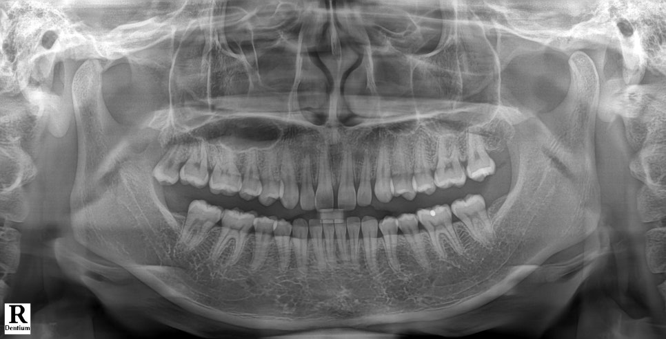 블랙트라이앵글 자연스럽게 메우는 비결은 이것 관련 이미지 7