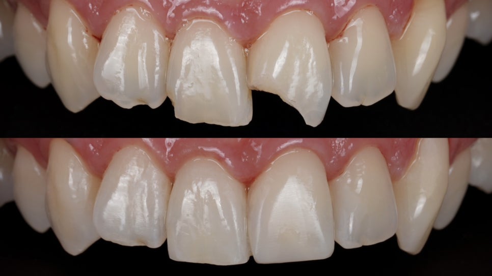 앞니 깨짐, 레진으로 감쪽같이 복원하는 방법 관련 이미지 2