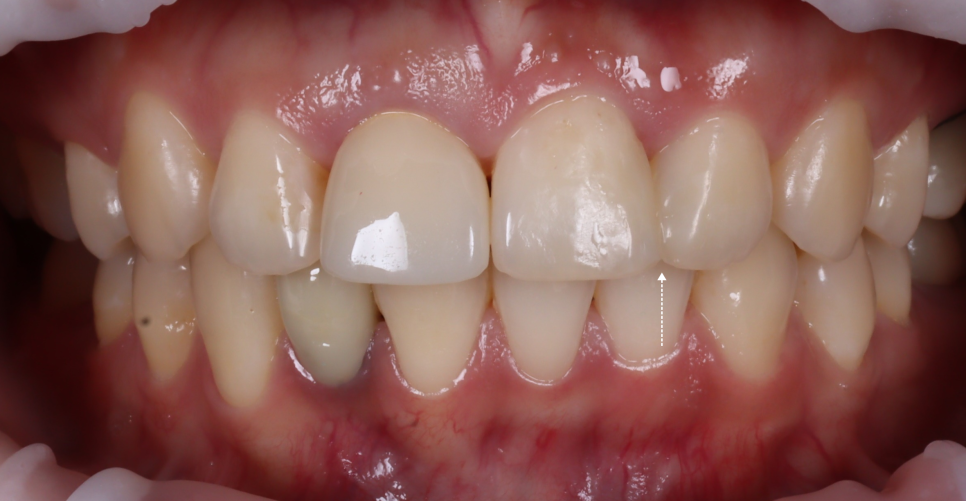 서초동치과 전라도 광주에서 레진 재치료 받으러 오신 사례 관련 이미지 3