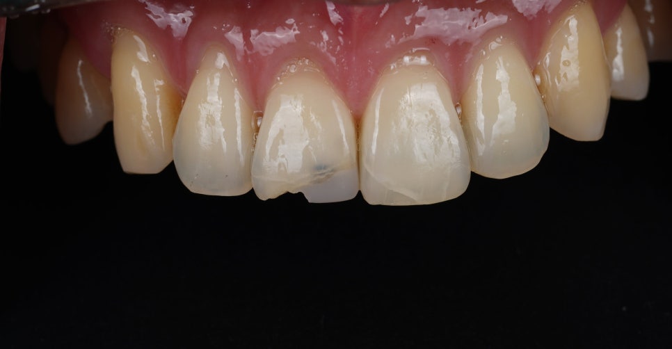강남역치과 앞니 파절 크라운 말고 레진으로 하세요 관련 이미지 3