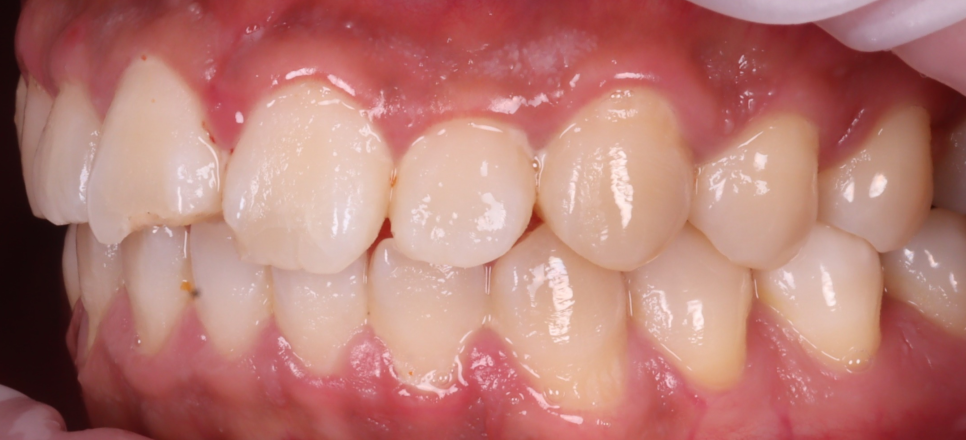 반포동치과 앞니 깨짐 레진 삭제 없이 당일에 치료 끝 관련 이미지 4