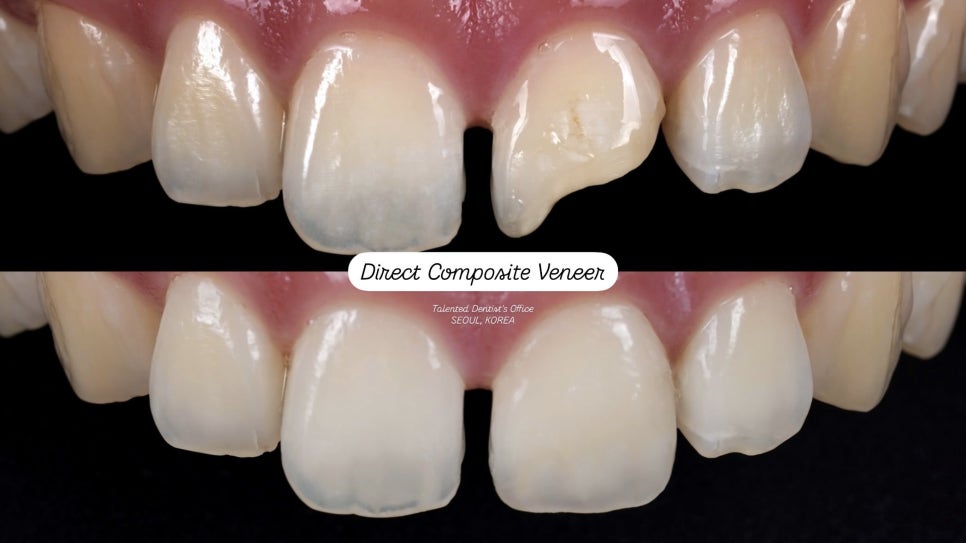 앞니 깨짐, 레진으로 감쪽같이 복원하는 방법 관련 이미지 4