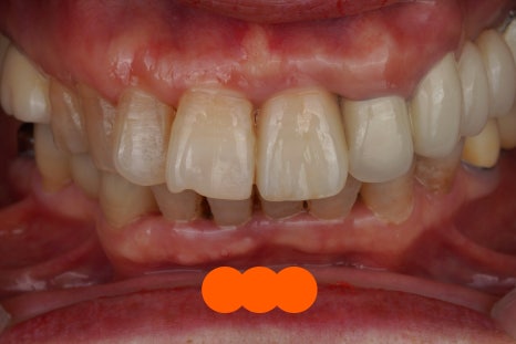 교대역 충치 치과, 신경치료 진단은 보수적으로 접근합니다. 관련 이미지 18