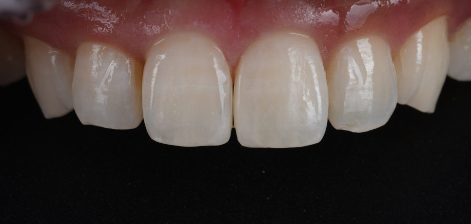 방배동치과 누렇고 벌어진 치아 미백과 레진 치료 관련 이미지 10