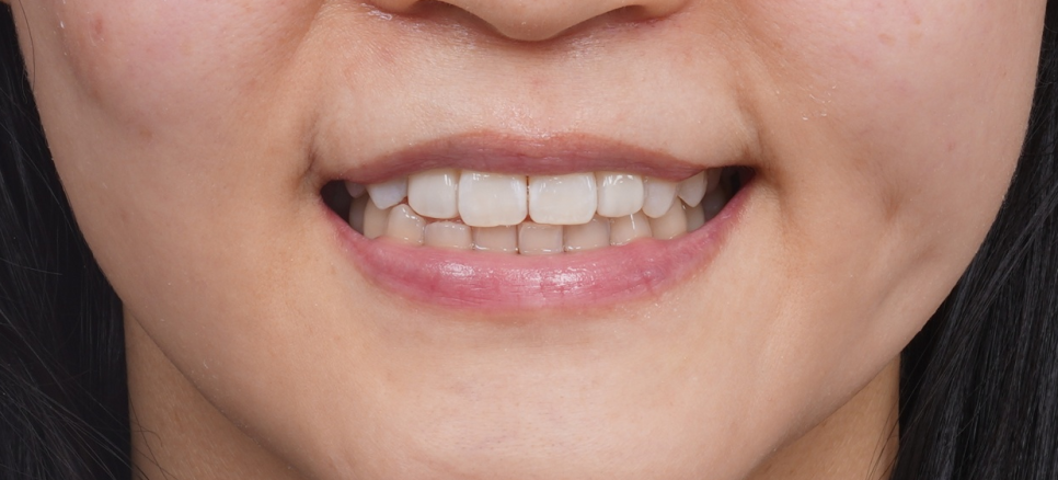 왜소치레진 20년 전에 했던 치아 재치료 후 반대쪽까지 관련 이미지 16