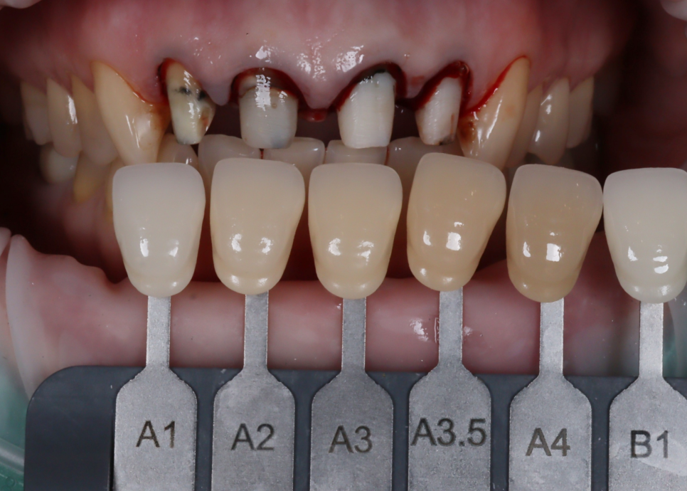 신논현치과 외국인 까만 앞니 크라운 교체 사례 관련 이미지 18