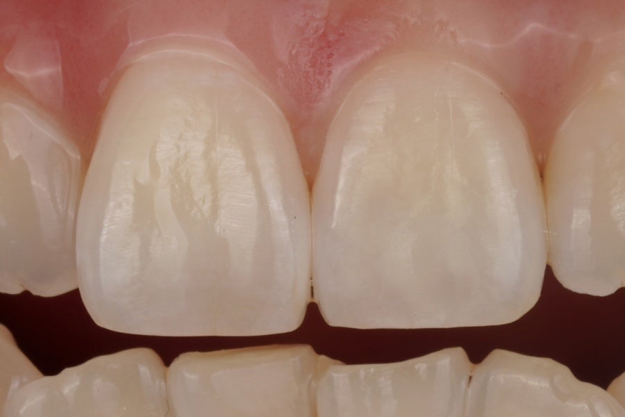 서초동 반점치 레진, 웨딩 촬영 전 앞니 치과치료 관련 이미지 4