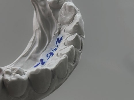 교대역 충치 치과, 신경치료 진단은 보수적으로 접근합니다. 관련 이미지 14