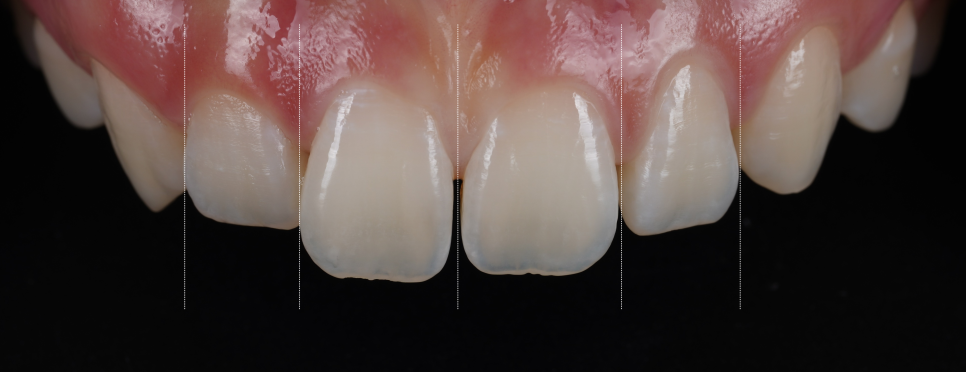역삼역치과 벌어진 앞니 레진 이렇게 해야 진짜 티 안나요 관련 이미지 9