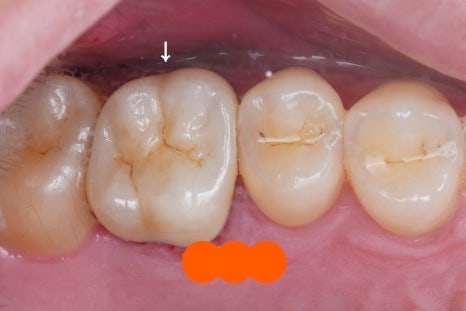 신경치료 후 크라운 씌운 치아 통증, 재신경치료 및 지르코니아 크라운 재치료 관련 이미지 7