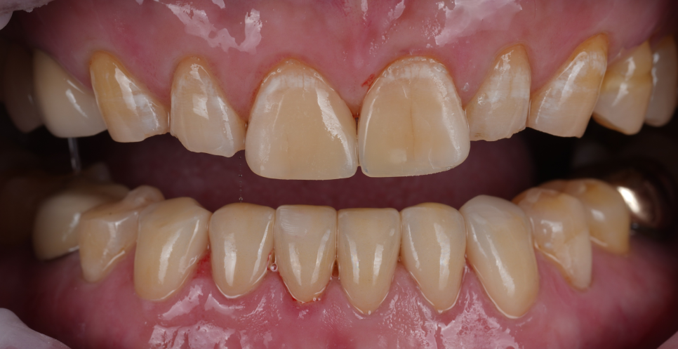 신논현역치과 심하게 마모된 60대 남성 앞니 크라운 치료 관련 이미지 15