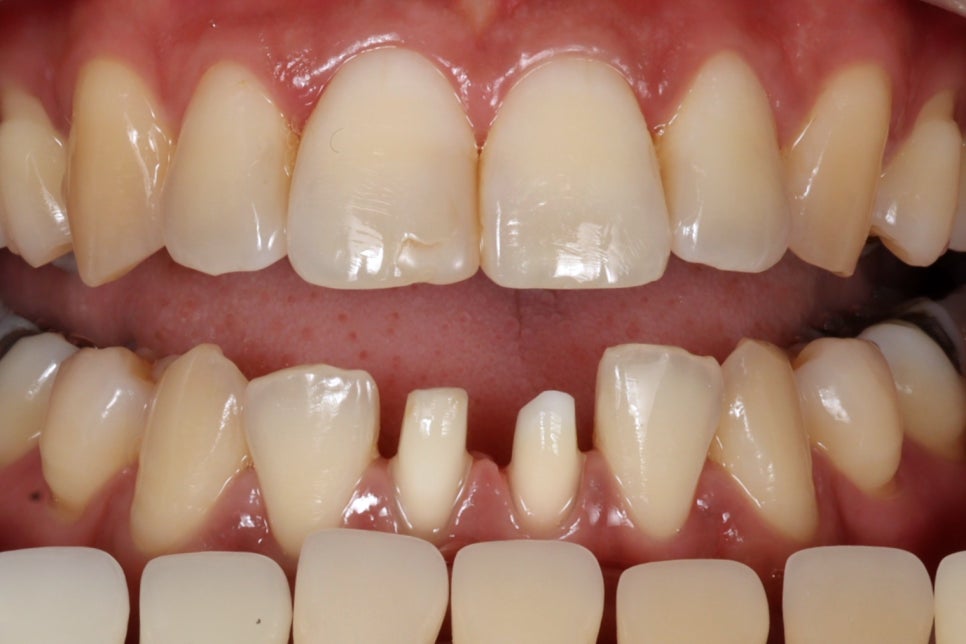 교대역 앞니 신경치료 후 지르코니아 크라운 치과 관련 이미지 5