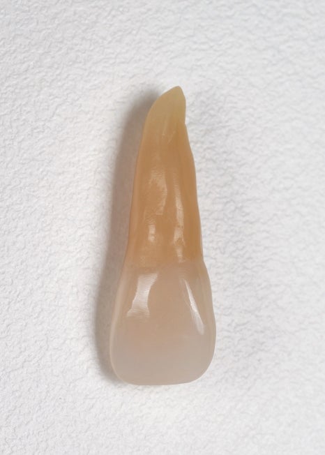 앞니 깨짐 레진 어디서할지 고민될 때 꼭 보세요 관련 이미지 3