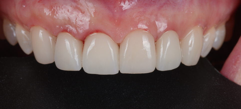 라미네이트, 크라운 재치료, 잇몸 성형까지 앞니 6개 치료 관련 이미지 12