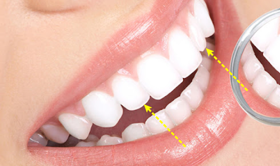 Apgujeong Dental Clinic: 3 Things Needed for Successful Resin Treatment of Peg Laterals image 2