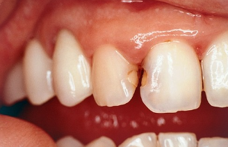 고속터미널역치과 레진치료 처음부터 잘 받아야 하는 이유 관련 이미지 4