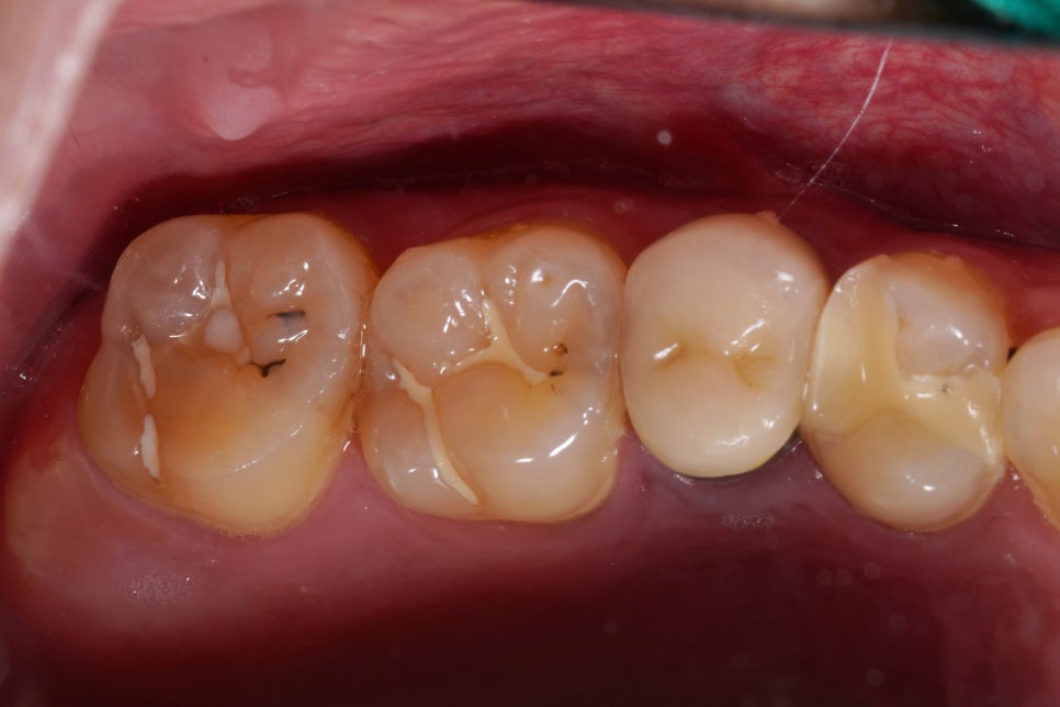 교대역 레진 실란트 밑에 깊은 2차충치 레진빌드업으로 당일 재치료 관련 이미지 1
