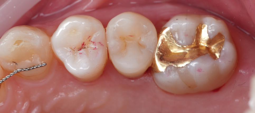 신경치료 후 크라운 안 하고 레진으로 할 수 있어요 관련 이미지 10