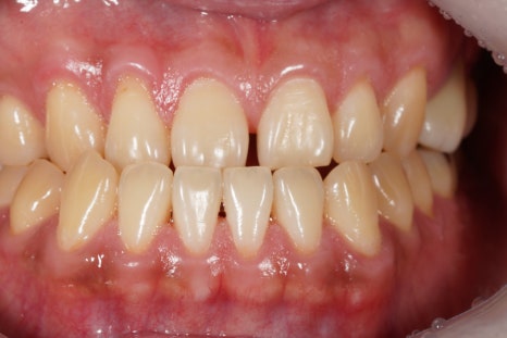 당신이 서울 교대역 재주좋은치과 라미네이트로 치료해야 하는 이유 관련 이미지 4