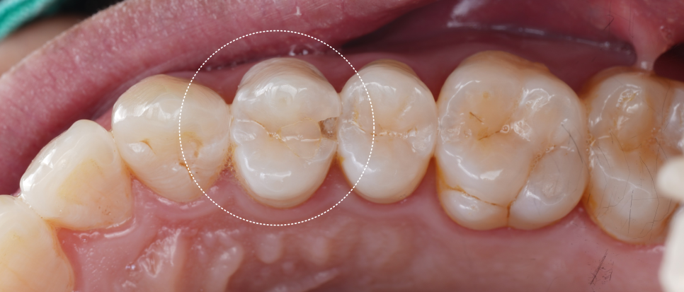 강남역치과 치료 부위 2차 충치 레진 재치료 사례 관련 이미지 4