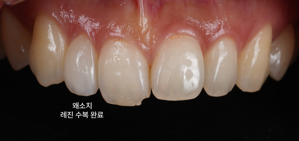 왜소치 레진으로 삭제 없이 예쁘게 관련 이미지 12