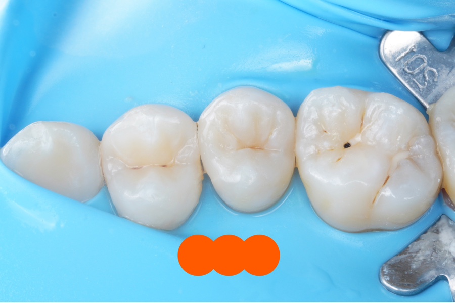 신경치료 할법한 어금니를 레진 빌드업으로 살려가는 이유 관련 이미지 7