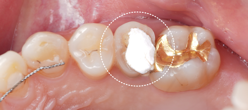신경치료 후 크라운 안 하고 레진으로 할 수 있어요 관련 이미지 2