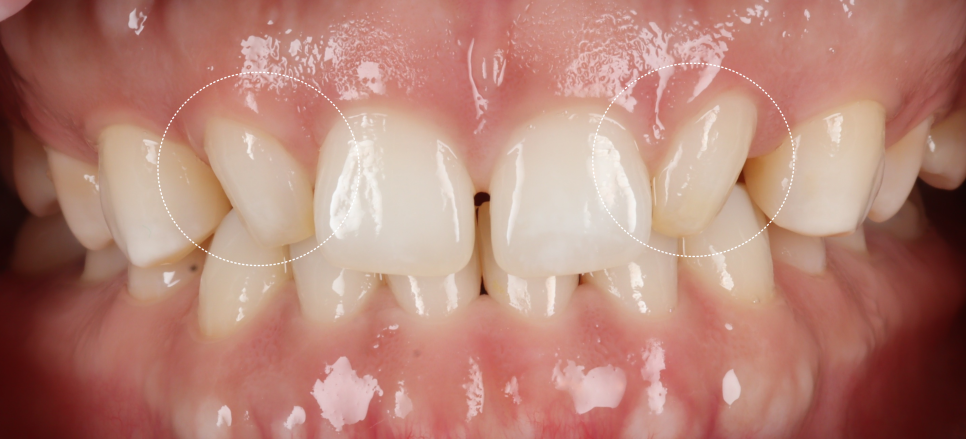 왜소치 라미네이트보다 레진 비니어를 더 추천드리는 이유 관련 이미지 2