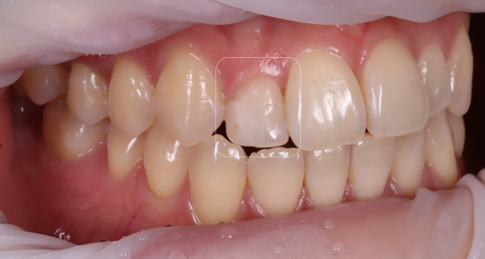 왜소치레진 20년 전에 했던 치아 재치료 후 반대쪽까지 관련 이미지 4
