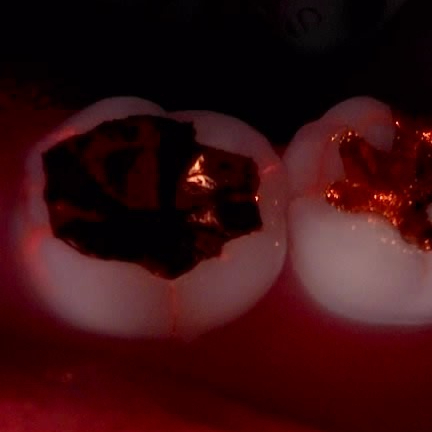 교대역 어금니 크랙 깨짐으로 씹을때 통증, 발치 피하고 신경치료로 유지한 케이스 관련 이미지 2