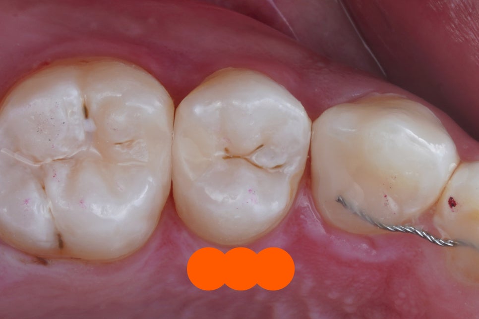 어금니 신경치료 안하고 레진빌드업, 교대역 치과 재주좋은치과 관련 이미지 4
